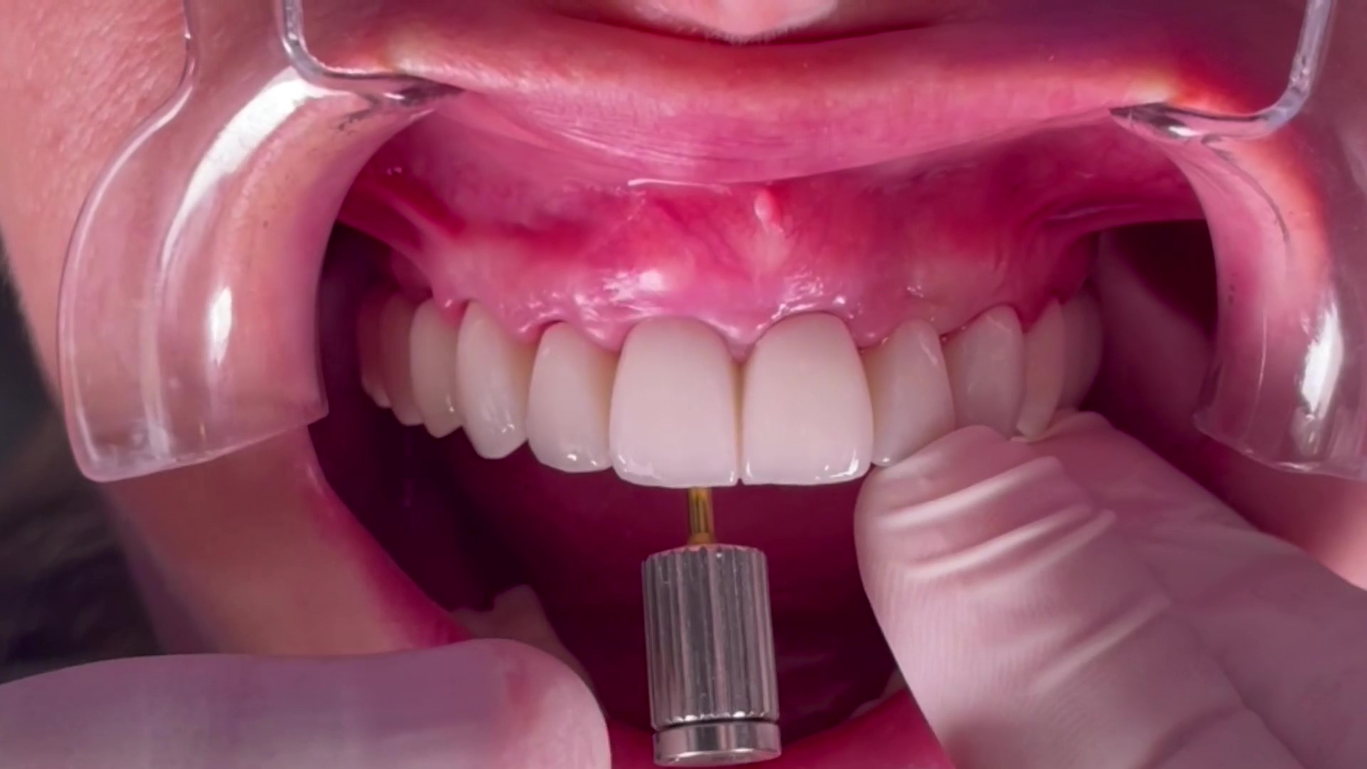 Comment entretenir un implant dentaire pour prolonger sa durée de vie ?