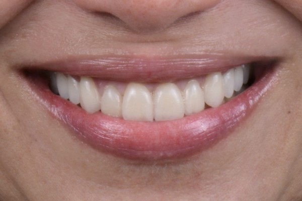 comment bien entretenir ces implants dentaires ?