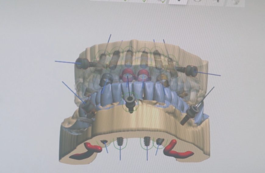 Qu’est ce que la chirurgie implantaire guidée en implantologie dentaire ?