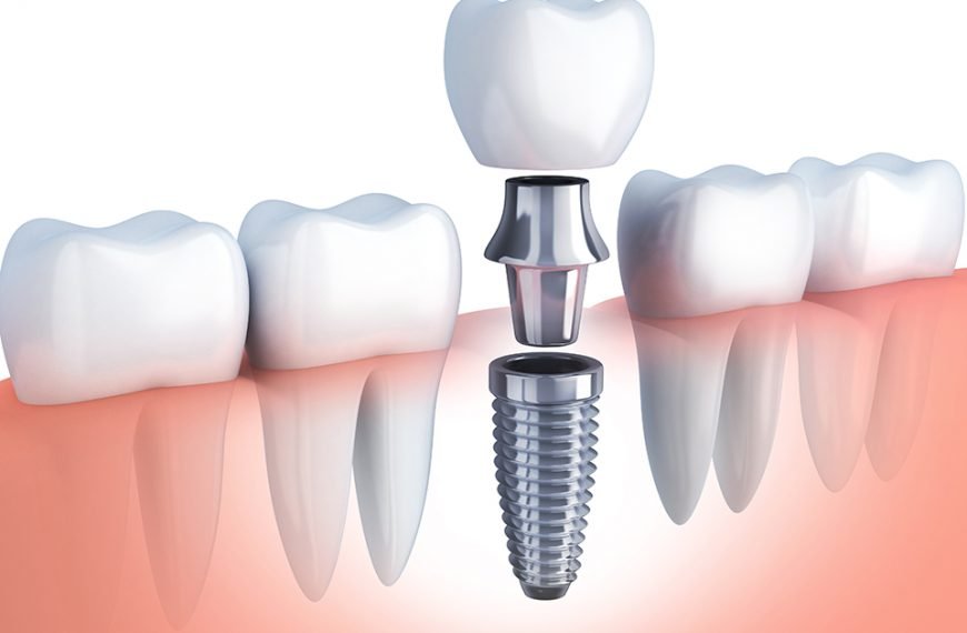 Comment est inséré dans l’os un implant dentaire ?