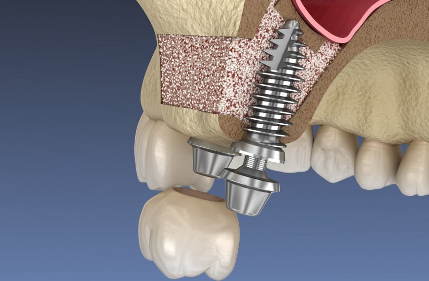 Le comblement de sinus en implantologie dentaire