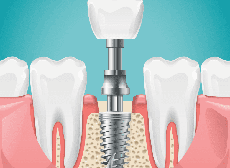 Peut on utiliser du fil dentaire pour nettoyer un implant dentaire ?