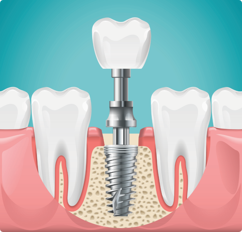 Peut on utiliser du fil dentaire pour nettoyer un implant dentaire ?