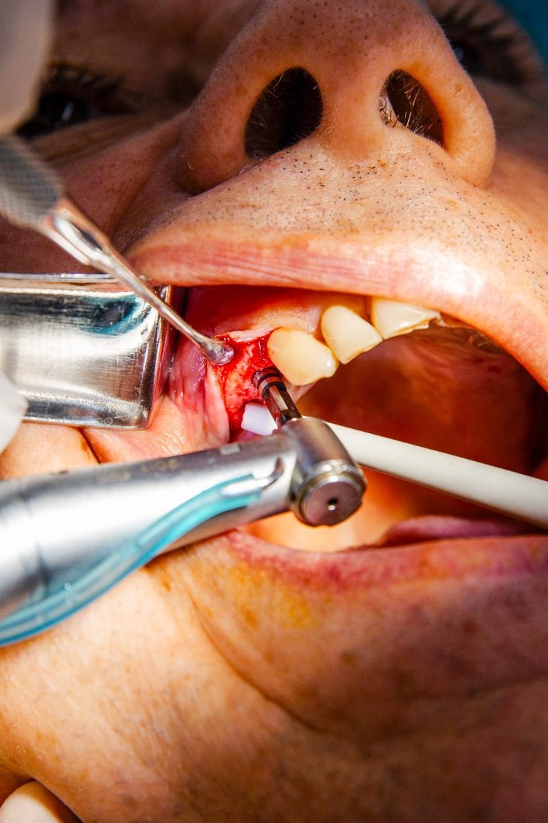 Chirurgie implant dentaire Porto