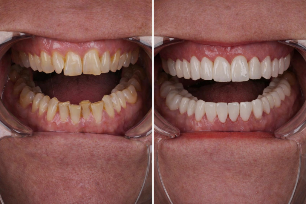 couronnes dentaires Portugal