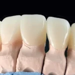 couronnes dentaires Portugal