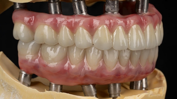 All-on-6 dental implants