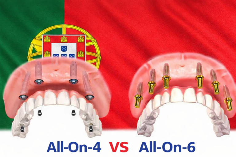All-On-4 vs All-On-6
