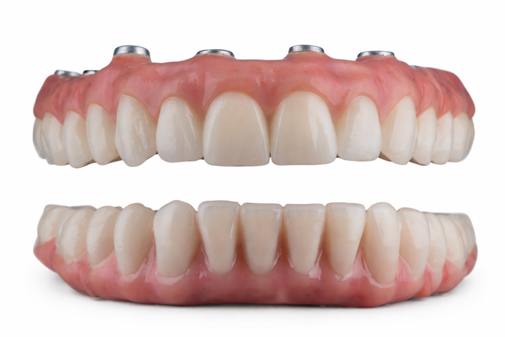 prothèse complète All-on-6 Portugal sur implants dentaires remplacement toutes les dents