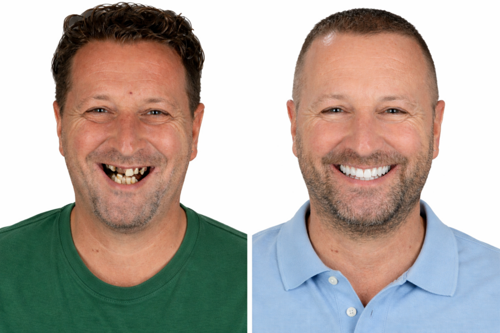 avant après sourire patient après traitement All-on-6 Portugal implants dentaires complets
